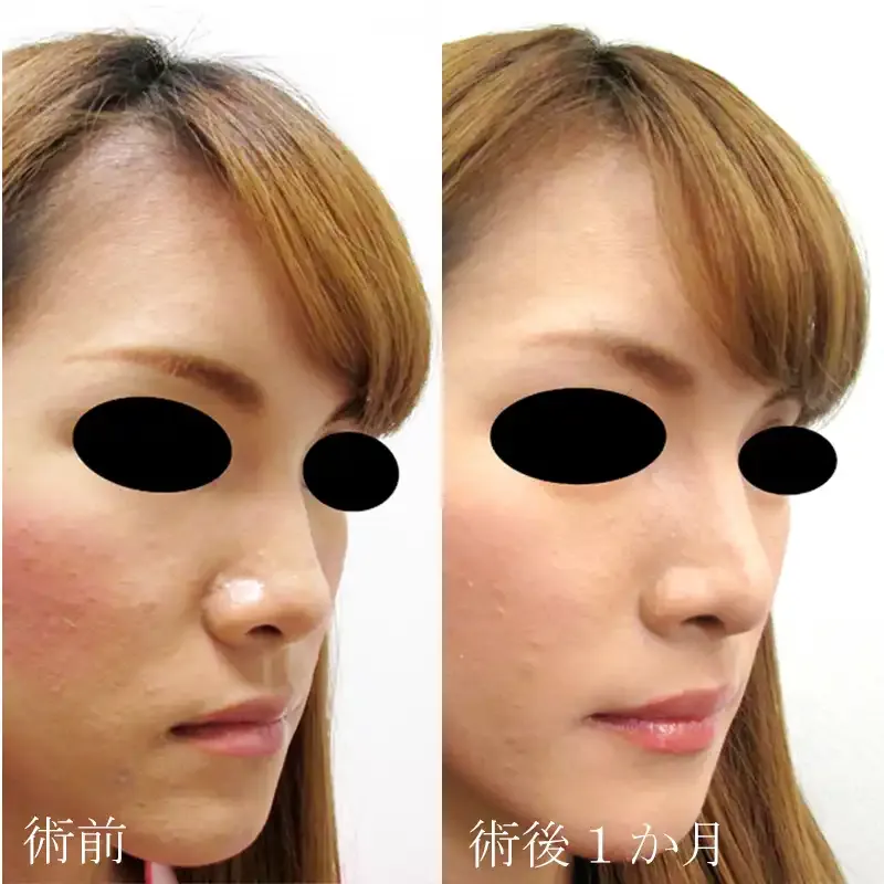 鼻中隔延長 症例写真1