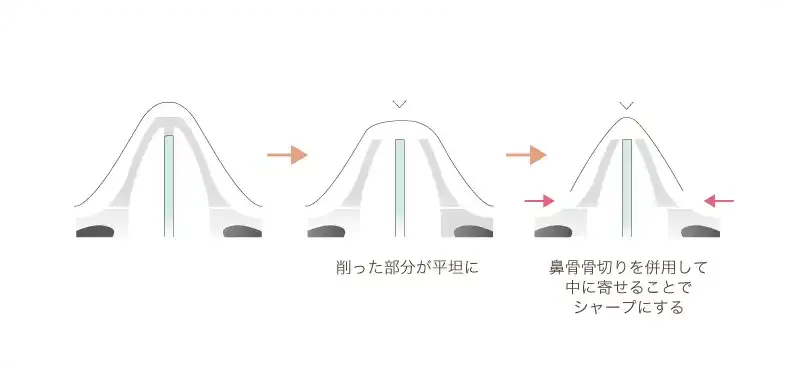 鼻骨骨切り