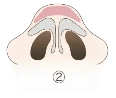 脂肪性(軟部組織性)のだんご鼻