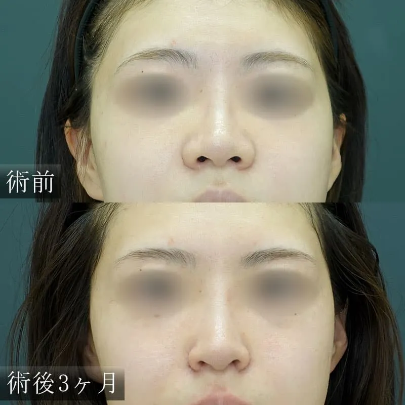 鼻翼縮小（2か所）・鼻翼幅寄せ(大腿筋膜）の症例写真