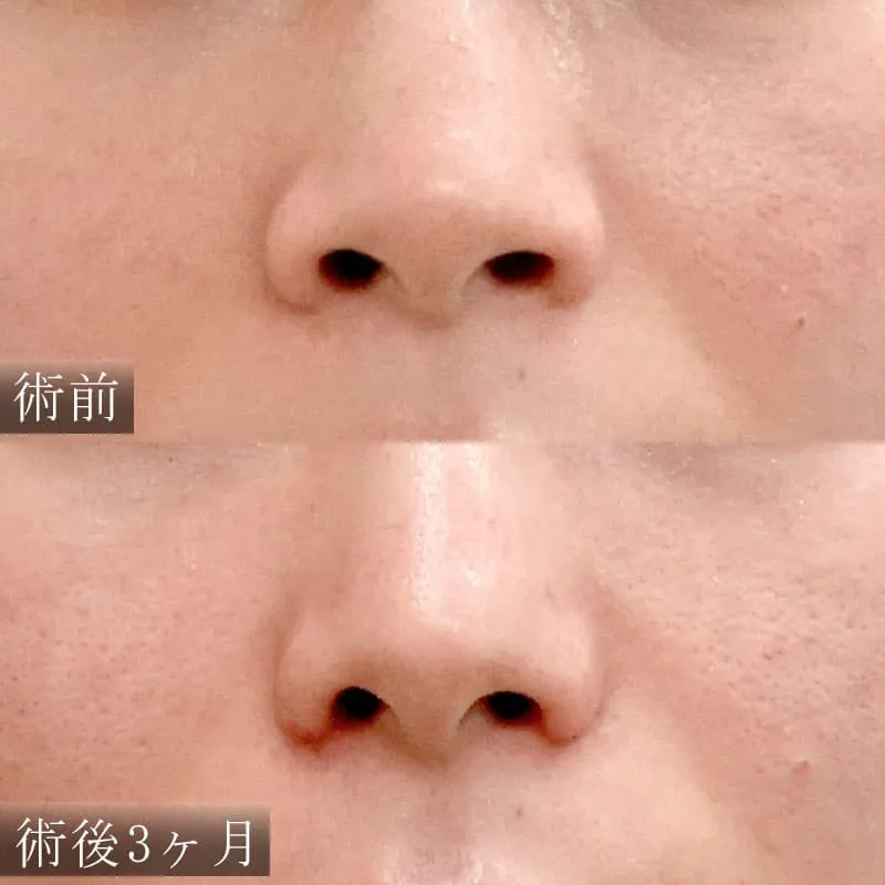 小鼻縮小の症例写真