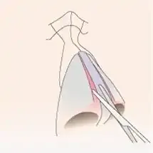 鼻中隔軟骨と外側鼻軟骨の切り離し