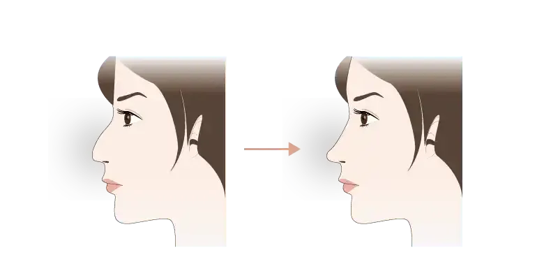 わし鼻修正とは