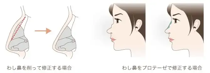 わし鼻をプロテーゼで修正