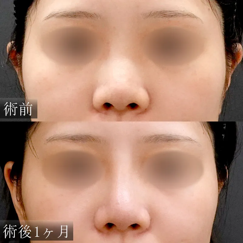 鼻プロテーゼの症例写真