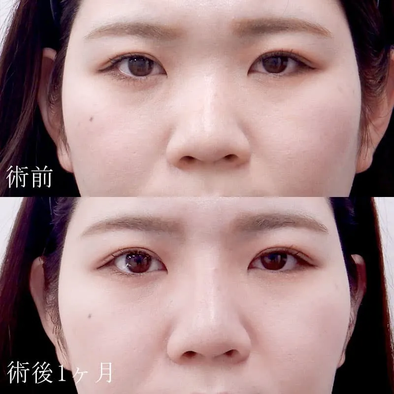 鼻プロテーゼの症例写真