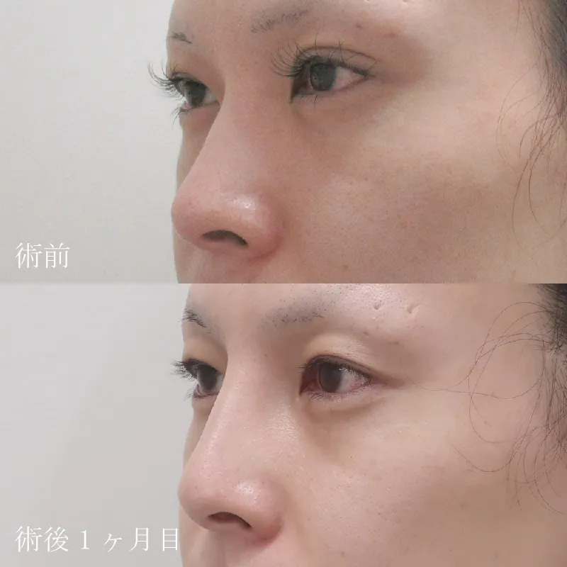 鼻プロテーゼの症例写真