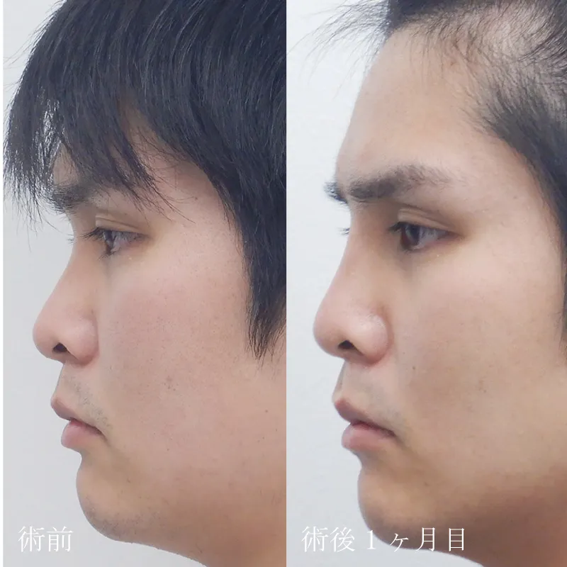 鼻プロテーゼの症例写真