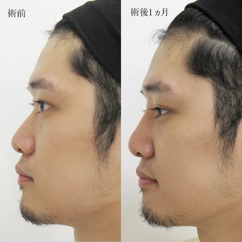 鼻プロテーゼの症例写真