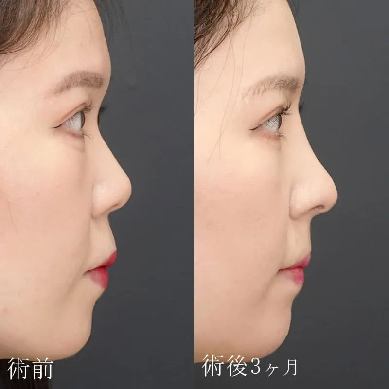 鼻中隔延長・鼻骨骨切りの症例写真
