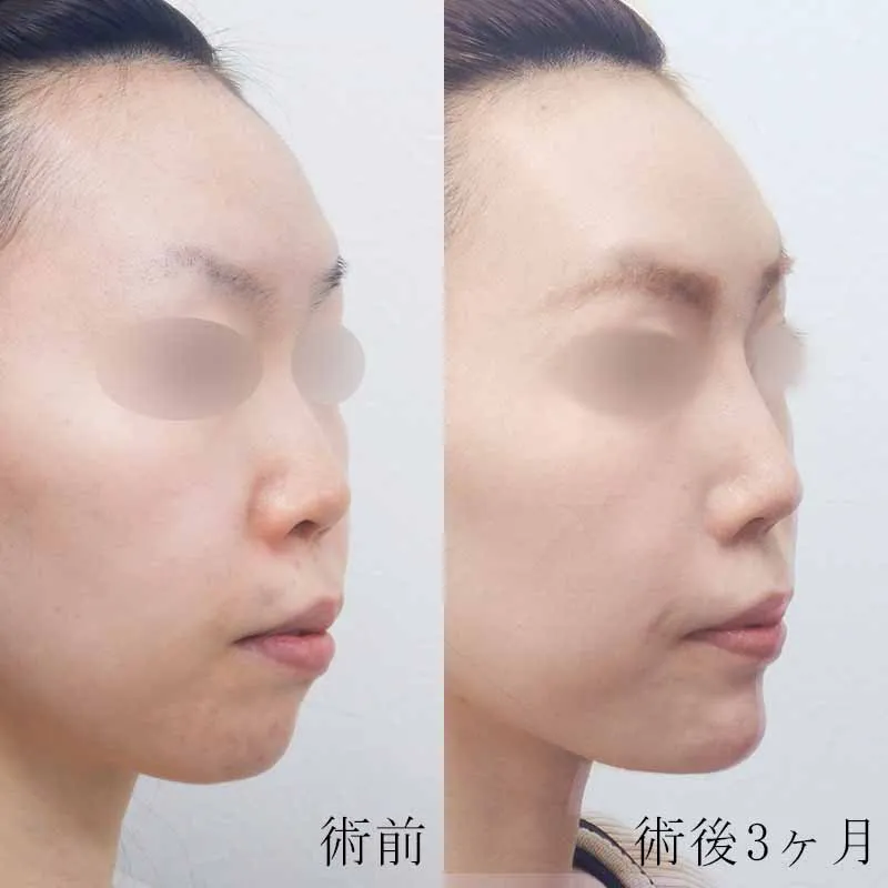 鼻プロテーゼの症例写真