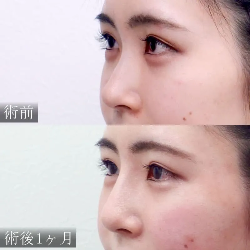 鼻プロテーゼの症例写真