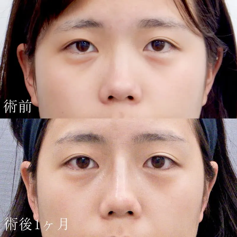 鼻プロテーゼの症例写真