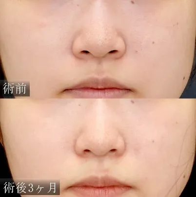 小鼻縮小の症例写真