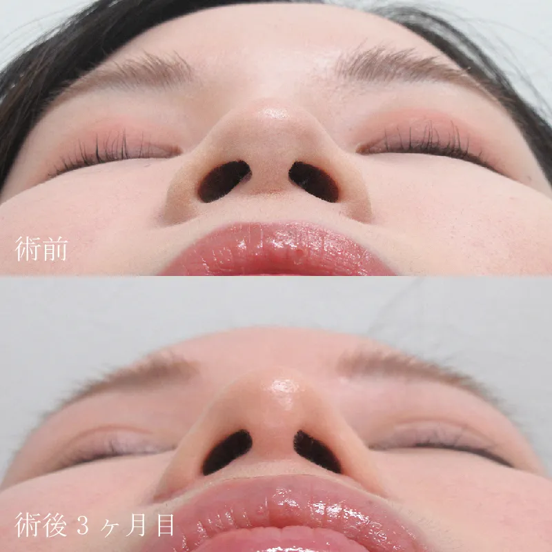 小鼻縮小の症例写真