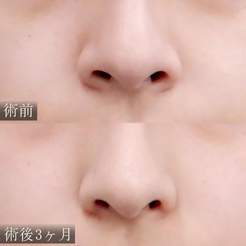 小鼻縮小の症例写真
