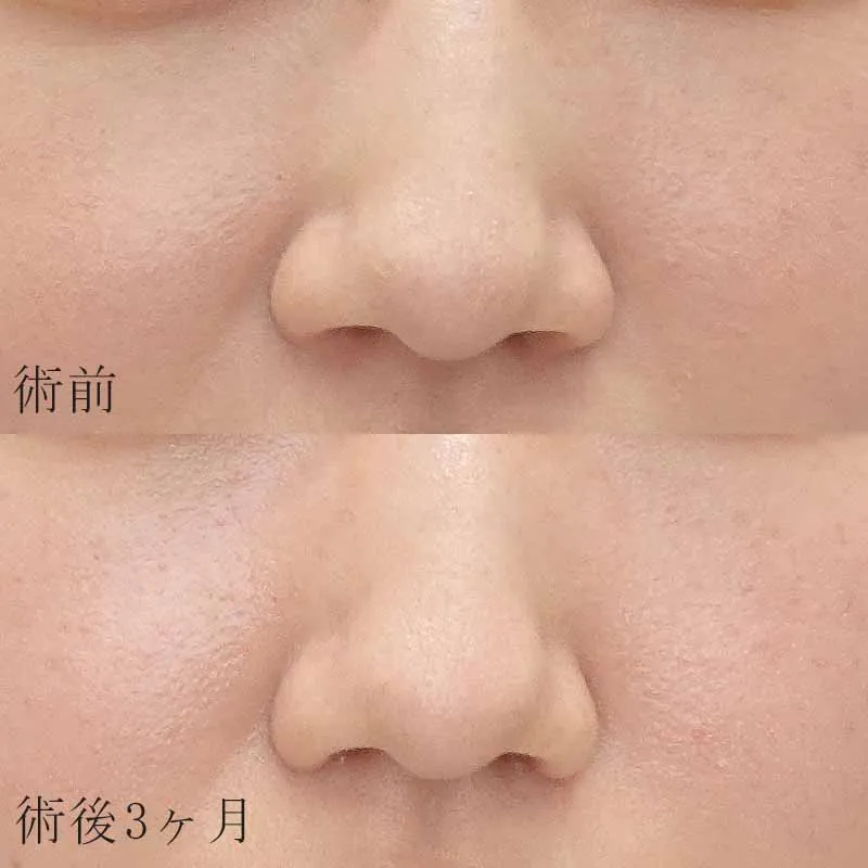 小鼻縮小の症例写真