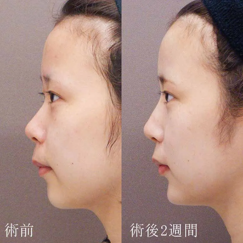 鼻のヒアルロン酸注入 症例写真3