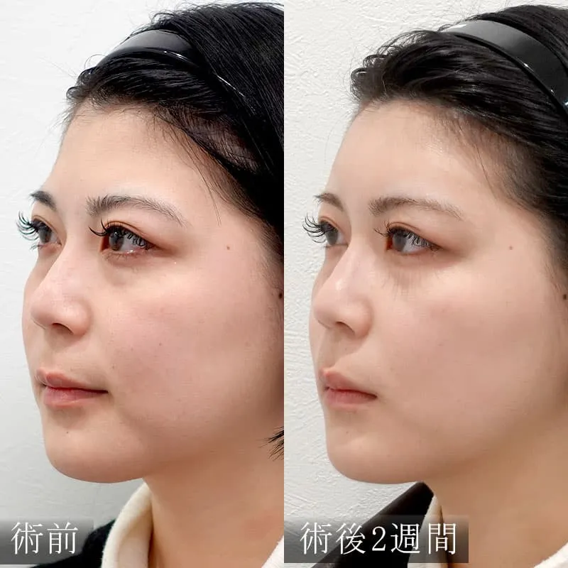 鼻・顎・唇のヒアルロン酸の症例写真