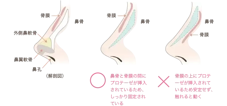 鼻プロテーゼの挿入位置