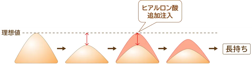 鼻のヒアルロン酸注入の特徴