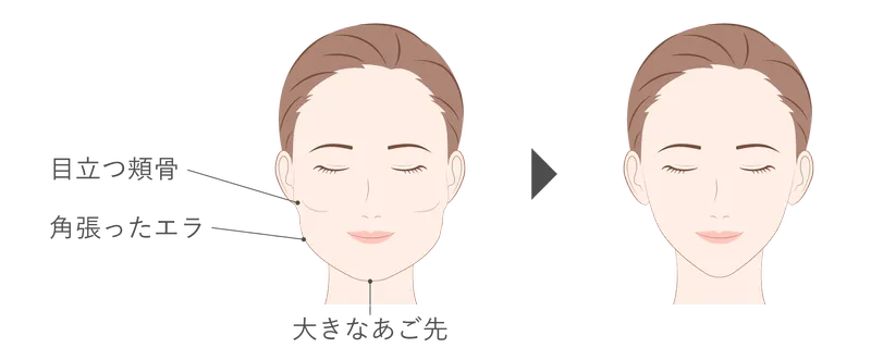 小顔形成術(輪郭3点)
