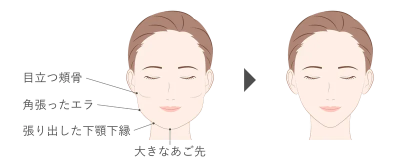 小顔形成術(輪郭4点フルセット)