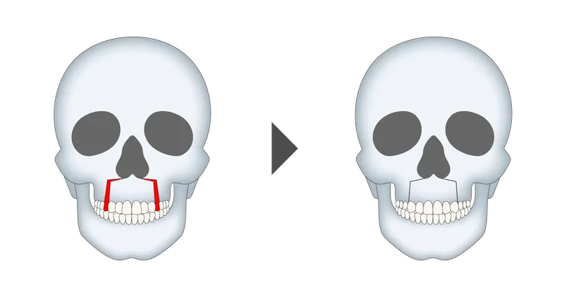上顎前歯部歯槽骨切り術（上顎セットバック）