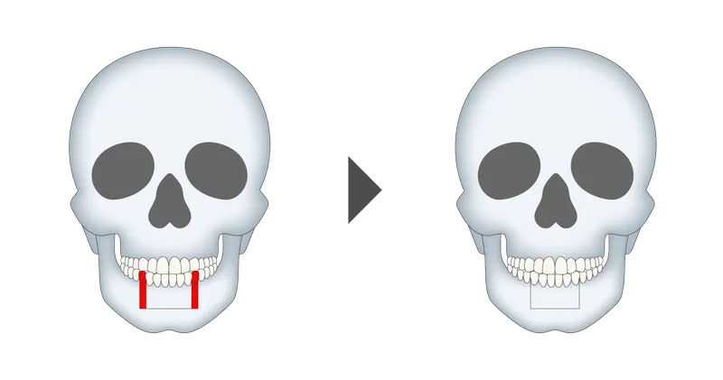 下顎前歯部歯槽骨切り術（下顎セットバック）