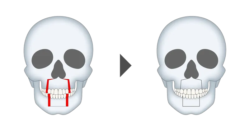 上下顎前歯部歯槽骨切り術（上下顎セットバック）