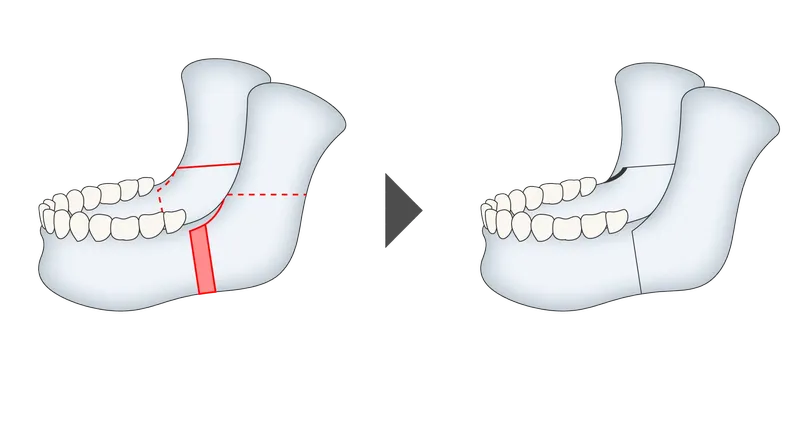 下顎枝矢状分割術（SSRO）