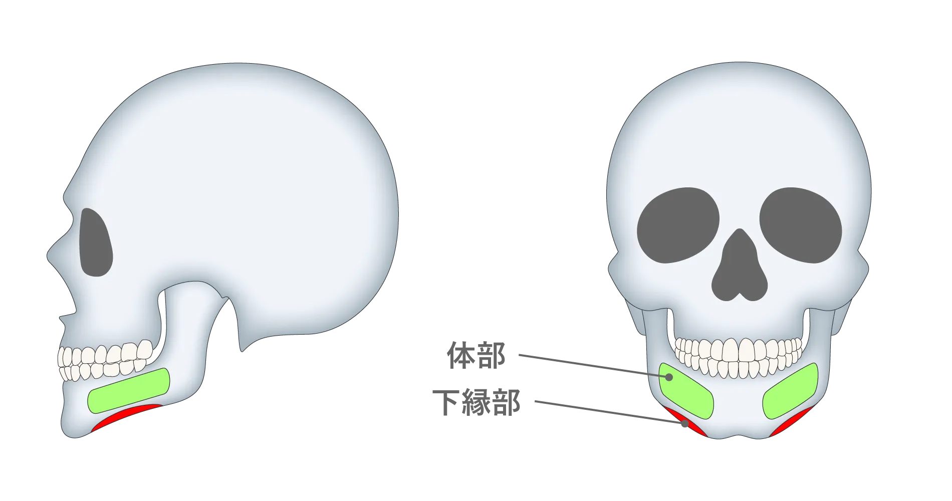 下顎下縁(体部)形成術の施術方法