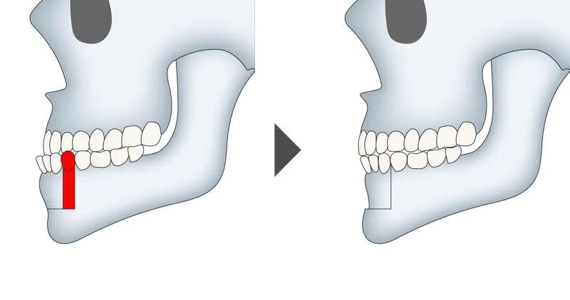 下顎セットバック