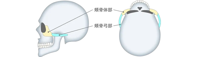 頬骨骨切り・骨削り術