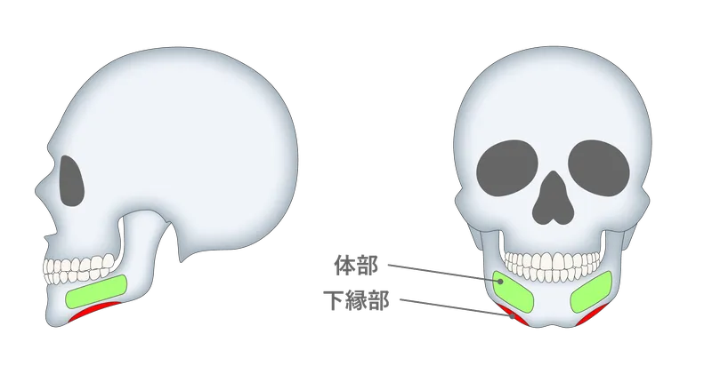 下顎下縁(体部)形成術