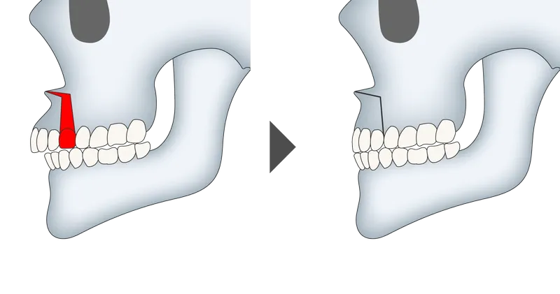 ミニ上顎セットバック