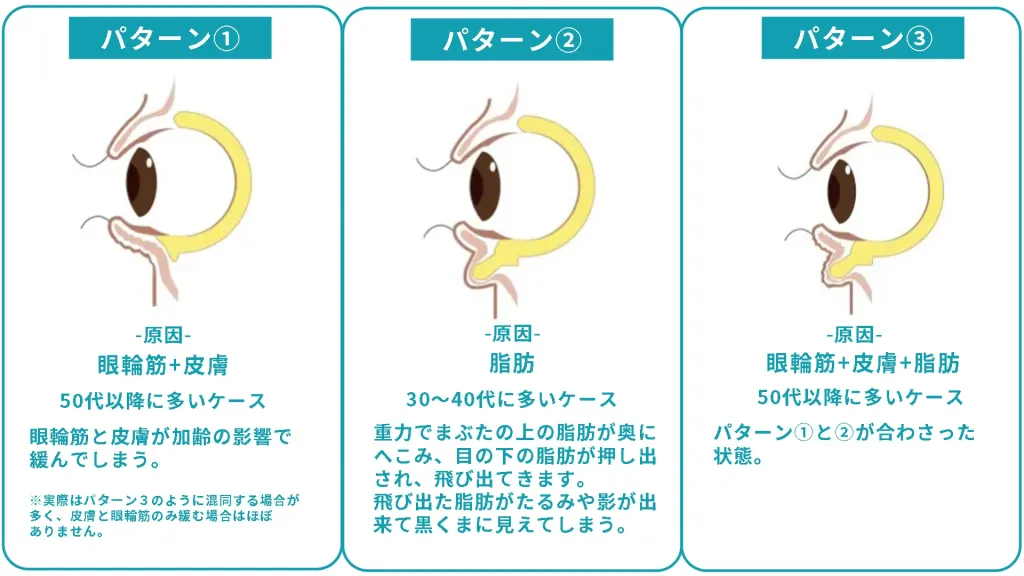 目の下のたるみ・クマの原因の３パータン