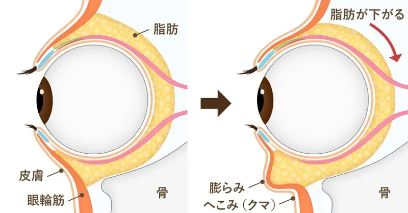 目の下のたるみについて