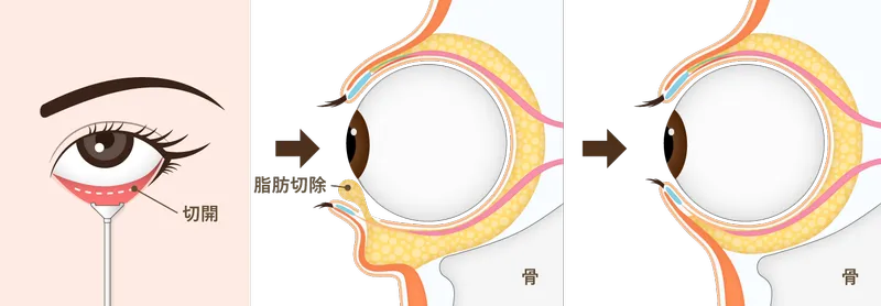 下眼瞼脱脂について