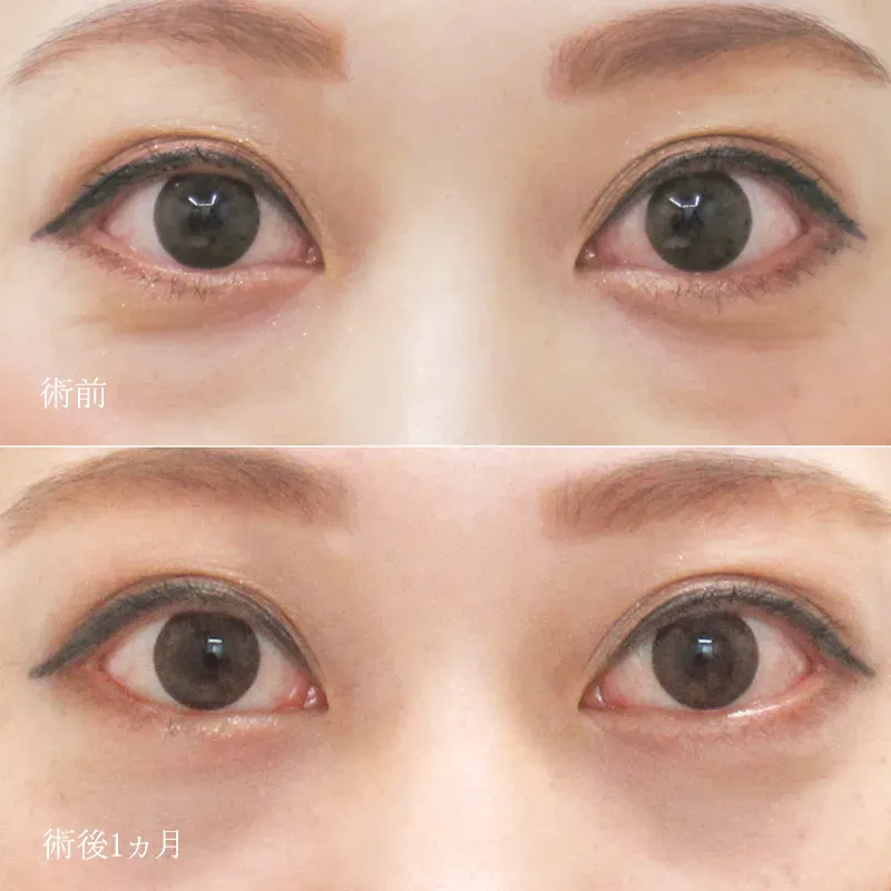 下眼瞼脱脂の症例写真2