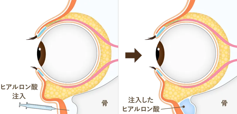 目の下のヒアルロン酸注入について