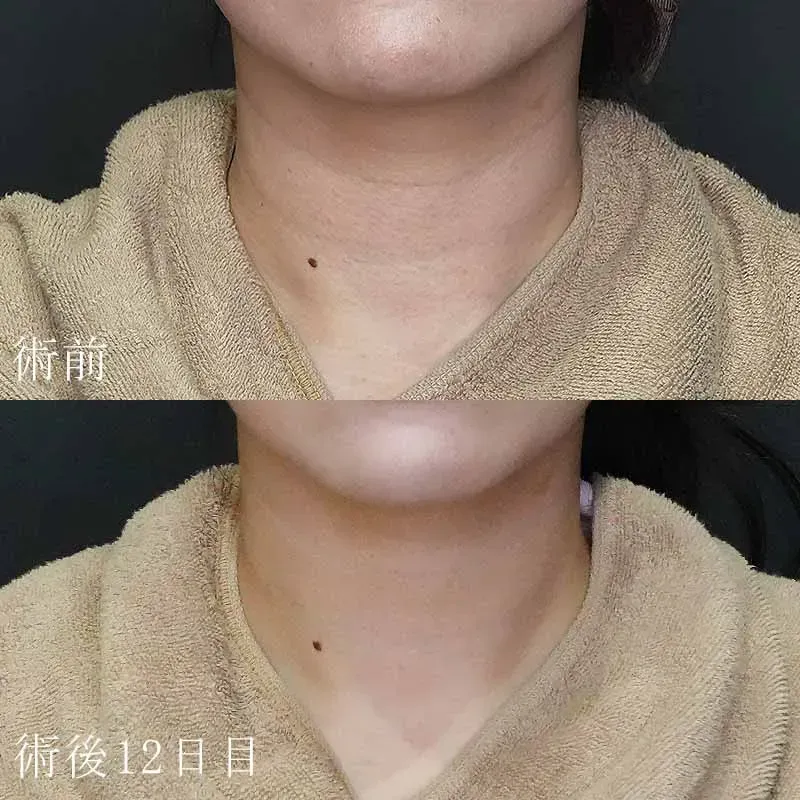 バイオスカルプチャーの症例写真