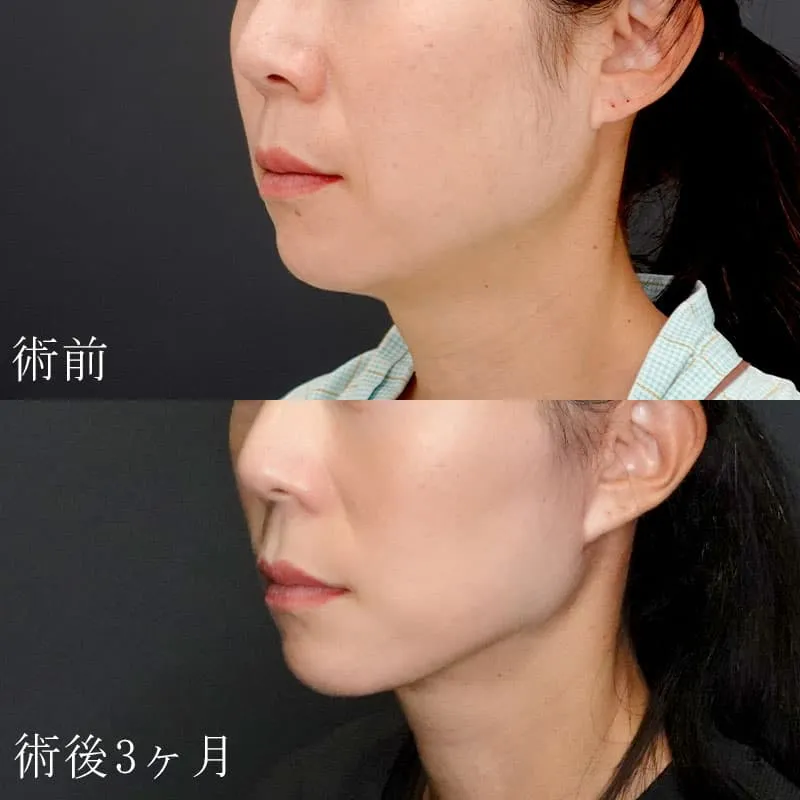 フェイスリフトの症例写真