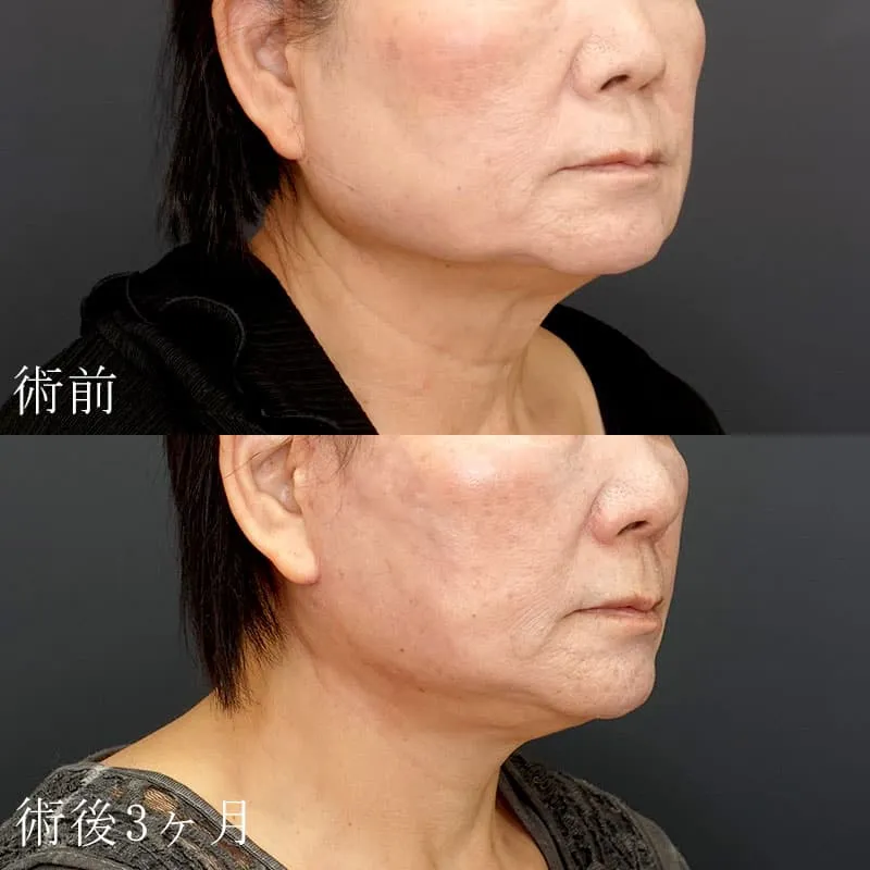 フェイスリフトの症例写真