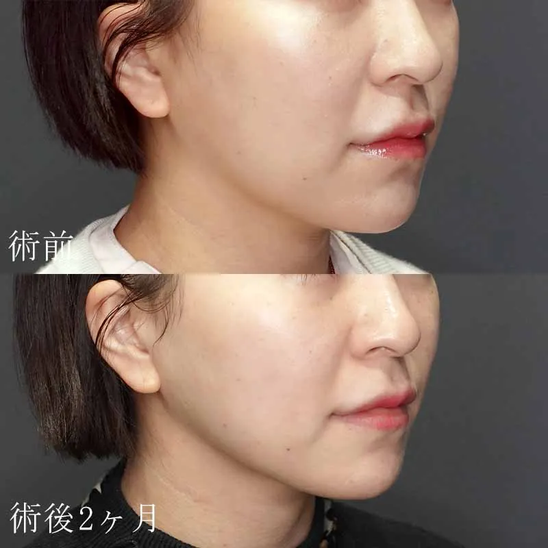 医療用ハイフ(HIFU)の症例写真
