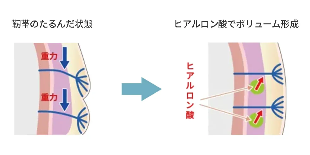 ヒアルロン酸によるボリューム形成