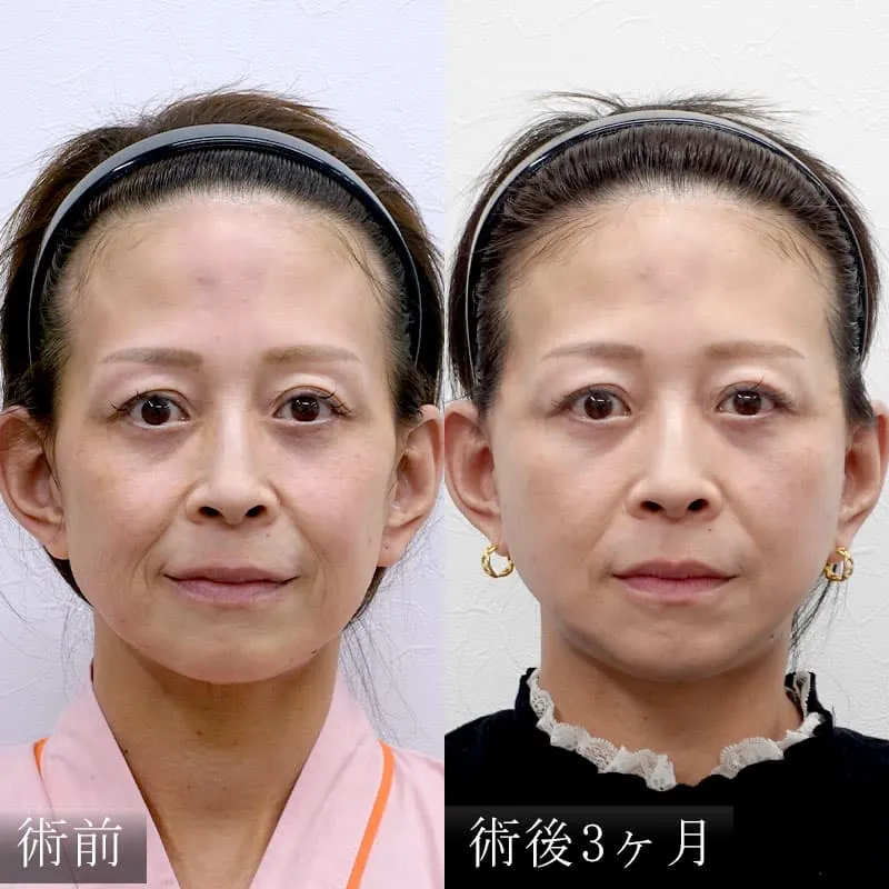 MACSリフトの症例写真