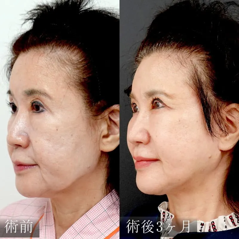 拡大MACSリフトの症例写真