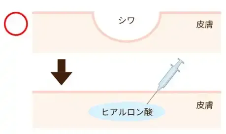 ボリューム形成の概念で注入