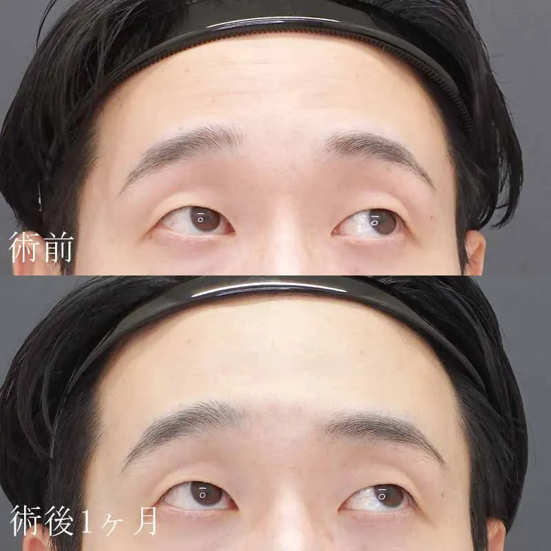 額のボトックス注射の症例写真